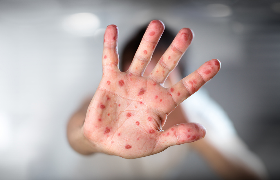 Addressing the Measles Outbreaks in New York